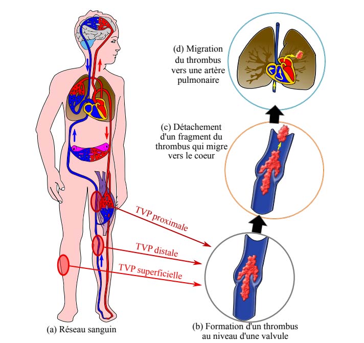 ENSTA Bretagne : recherche sur la formation de thrombus